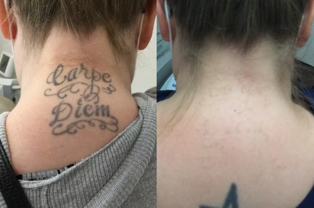 Permanent Tattoo Removal in Gurgaon, LaserTattoo Removal